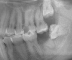歯牙移植 0.bmp