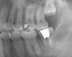 歯牙移植1.BMP