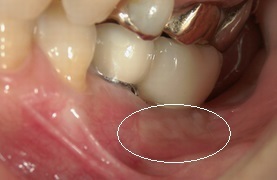 口腔外科/歯肉再生1.bmp