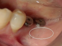 口腔外科/歯肉再生0.bmp