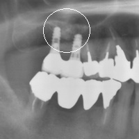 インプラント 松戸市・市川市.bmp